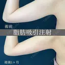 振り袖の部分痩せ❗脂肪吸引注射 💉 30日後 サムネイル用