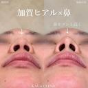 Dr加賀デザイン＊鼻ヒアルロン酸コルメラストラット法 before画像 サムネイル用
