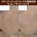 ピコレーザートーニング before画像 サムネイル用