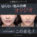 ”オリジオ”でリフトアップ小顔転生❤️‍🔥 after画像 サムネイル用