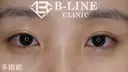 【韓流目頭切開術・切開法二重術】手術後3ヵ月 before画像 サムネイル用