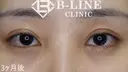 【韓流目頭切開術・切開法二重術】手術後3ヵ月 after画像 サムネイル用