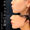 鼻尖形成3D法＋軟骨移植 90日後 サムネイル用