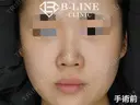 【Gメッシュ】1週間後 before画像 サムネイル用