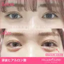 涙袋ヒアルロン酸 after画像 サムネイル用