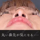 鼻ヒアルロン酸(コルメラストラット法) before画像 サムネイル用