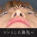鼻ヒアルロン酸(コルメラストラット法) after画像 サムネイル用