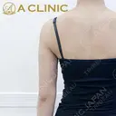 【二の腕スリム脂肪吸引】二の腕スリム脂肪吸引で腕が綺麗なストレートに変化！処置前と2ヶ月後の症例です after画像 サムネイル用