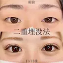 二重埋没法 30日後 サムネイル用