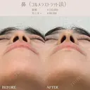 鼻先ヒアルロン酸( コルメラストラット法 ) after画像 サムネイル用