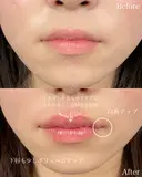 Cカールリップ before画像 サムネイル用