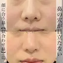 プロテーゼ＋鼻尖形成＋軟骨移植＋鼻柱下降＋鼻翼縮小 before画像 サムネイル用