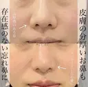プロテーゼ＋鼻尖形成＋軟骨移植＋鼻柱下降＋鼻翼縮小 after画像 サムネイル用