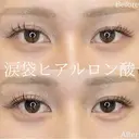 涙袋ヒアルロン酸 after画像 サムネイル用