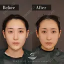 輪郭3点（エラ＋頬骨＋オトガイ） 60日後 サムネイル用