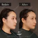 輪郭3点（エラ＋頬骨＋オトガイ） 60日後 サムネイル用