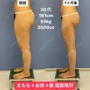 スラリとした美脚へ💃脂肪吸引 30日後 サムネイル用
