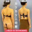 華奢な肩回りを作る💘美ボディ脂肪吸引 30日後 サムネイル用