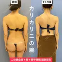 華奢な肩回りを作る💘美ボディ脂肪吸引 30日後 サムネイル用