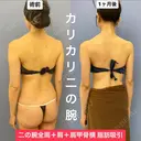華奢な肩回りを作る💘美ボディ脂肪吸引 30日後 サムネイル用