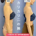 華奢な肩回りを作る💘美ボディ脂肪吸引 30日後 サムネイル用