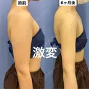 真っ直ぐ美しい二の腕💗脂肪吸引 180日後 サムネイル用