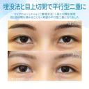 【20代女性・憧れの平行型二重に】目上切開（3ヶ月後） before画像 サムネイル用