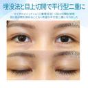 【20代女性・憧れの平行型二重に】目上切開（3ヶ月後） after画像 サムネイル用