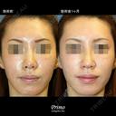 Q 鼻中隔延長術＋隆鼻術 before画像 サムネイル用