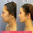 Eラインも輪郭も美しく💕 before画像 サムネイル用