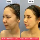 Eラインも輪郭も美しく💕 365日後 サムネイル用