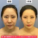 Eラインも輪郭も美しく💕 365日後 サムネイル用