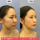 Eラインも輪郭も美しく💕 365日後 サムネイル用