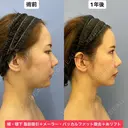 Eラインも輪郭も美しく💕 365日後 サムネイル用