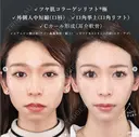 【人中短縮×糸リフト】のトータルビューティー after画像 サムネイル用
