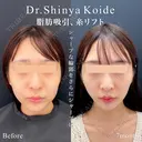 小顔脂肪吸引(頬＋あご下＋ジョールファット)＋アプリリフト4本 before画像 サムネイル用