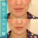 ヒアルロン酸注入（あご） before画像 サムネイル用