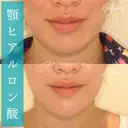 ヒアルロン酸注入（あご） 60日後 サムネイル用
