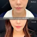 アプリリフト10本＋ヒアルロン酸(法令線) 7日後 サムネイル用