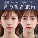鼻尖形成＋軟骨移植＋鼻中隔延長術＋プロテーゼ after画像 サムネイル用