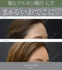 ふっくら丸いおでこ😌額ヒアルロン酸 after画像 サムネイル用