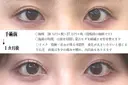 目頭切開法 before画像 サムネイル用