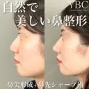 【🌷鼻尖形成・鼻先シャープ術🌷】 after画像 サムネイル用