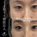 目の下のクマ取り before画像 サムネイル用