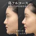 鼻フルコース（鼻複合自家組織移植術）＋小鼻縮小術 before画像 サムネイル用