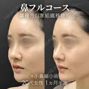 鼻フルコース（鼻複合自家組織移植術）＋小鼻縮小術 30日後 サムネイル用
