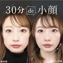 糸リフト、ジョールファット除去、アゴのヒアルロン酸注射、エラのボツリヌストキシン注射 before画像 サムネイル用