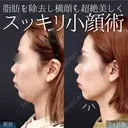糸リフト、アゴ下の脂肪吸引、Lラインファット除去、エラのボツリヌストキシン注射、アゴのヒアルロン酸注射、アゴのボツリヌストキシン注射 before画像 サムネイル用