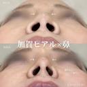 加賀デザイン＊鼻ヒアルロン酸(コルメラストラット法) before画像 サムネイル用