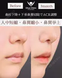 人中短縮・鼻翼縮小・鼻翼挙上 before画像 サムネイル用